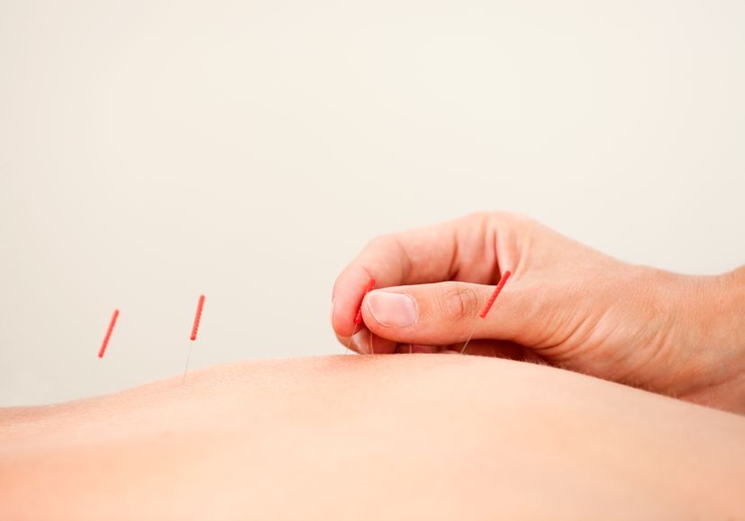 Infertility Problems? Try Acupuncture