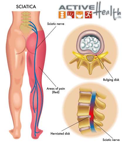 help for sciatica