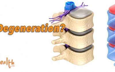 A Chiropractic Look at Spinal Degeneration