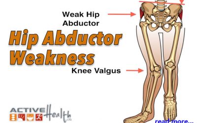 Condition of the Month – Hip Abductor Weakness