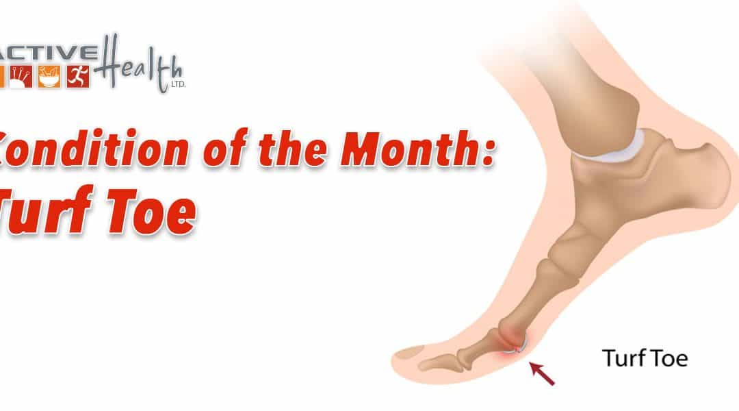 Condition of the Month – (Turf Toe)