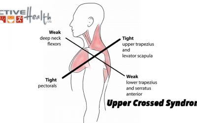 Upper Crossed Syndrome