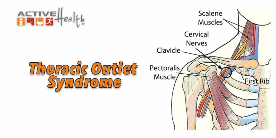 Thoracic-Outlet--Syndrome - Chiropractor - Park Ridge, IL - Active Health