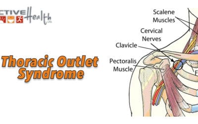 Thoracic Outlet Syndrome