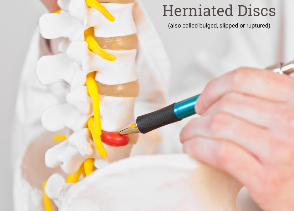 How a Chiropractor Can Help Your Herniated Disk